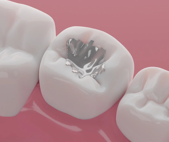 3D dental restoration showing tooth cavity treatment with filling material on pink background