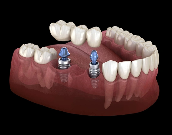 Dental implants illustration showing two blue implant posts in jaw model with prosthetic teeth.