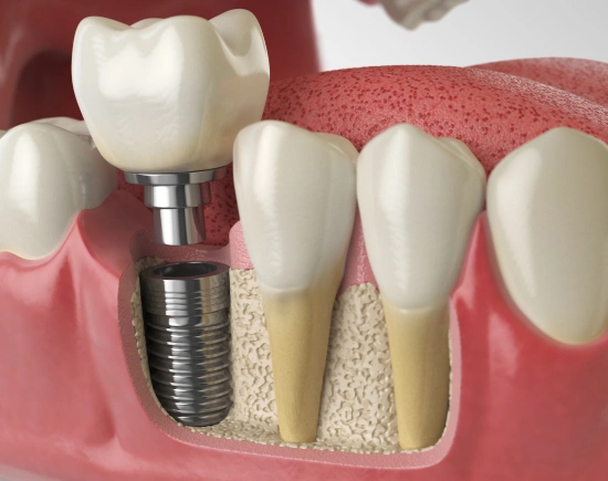 Dental implant diagram showing titanium screw, abutment, and crown components in jaw model.