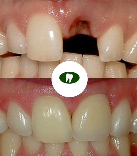 Real smile transformation- Dentist in Tucson