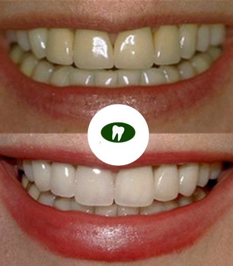 Real smile transformation- Dentist Tucson